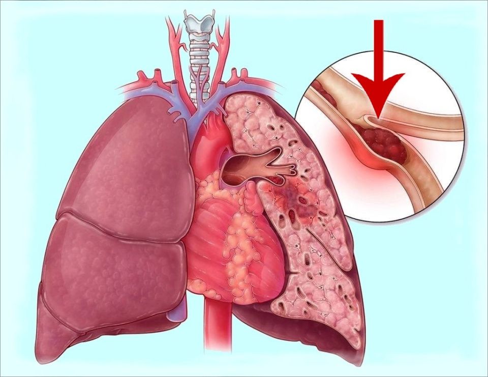 Как тромбы могут стать серьезной опасностью во сне