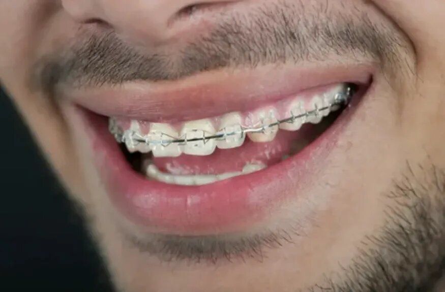 Брекеты и призыв: на грани военной службы