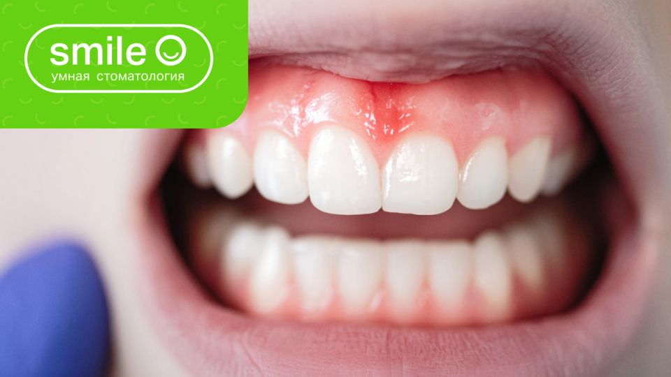 Белый налет на деснах: стоит ли паниковать или это просто обычное явление?