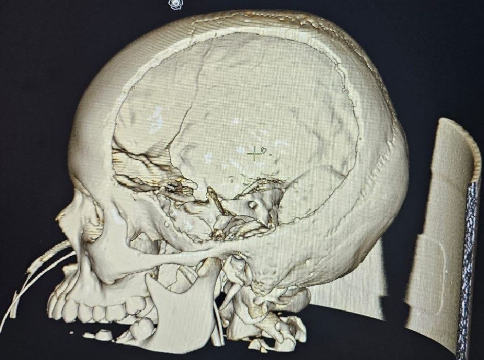 Орловские нейрохирурги спасли 13-летнего мальчика с кровоизлиянием в мозг