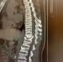Орловские врачи провели сложную операцию на позвоночнике
